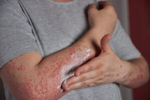 Woman applying moisturizer to skin with psoriasis with her hand on her forearm