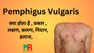 45. pemphigus vulgaris