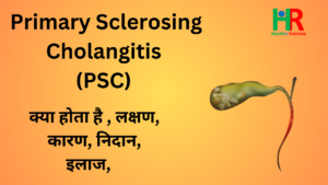 47. Primary Sclerosing Cholangitis