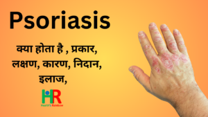 48. Psoriasis