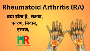 51. Rheumatoid Arthritis