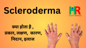 52. Scleroderma