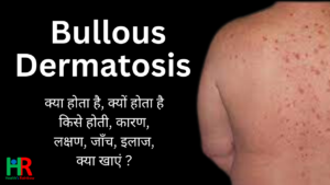 Bullous dermatosis