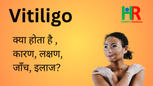 Vitiligo