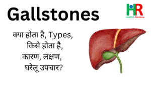 gall stones